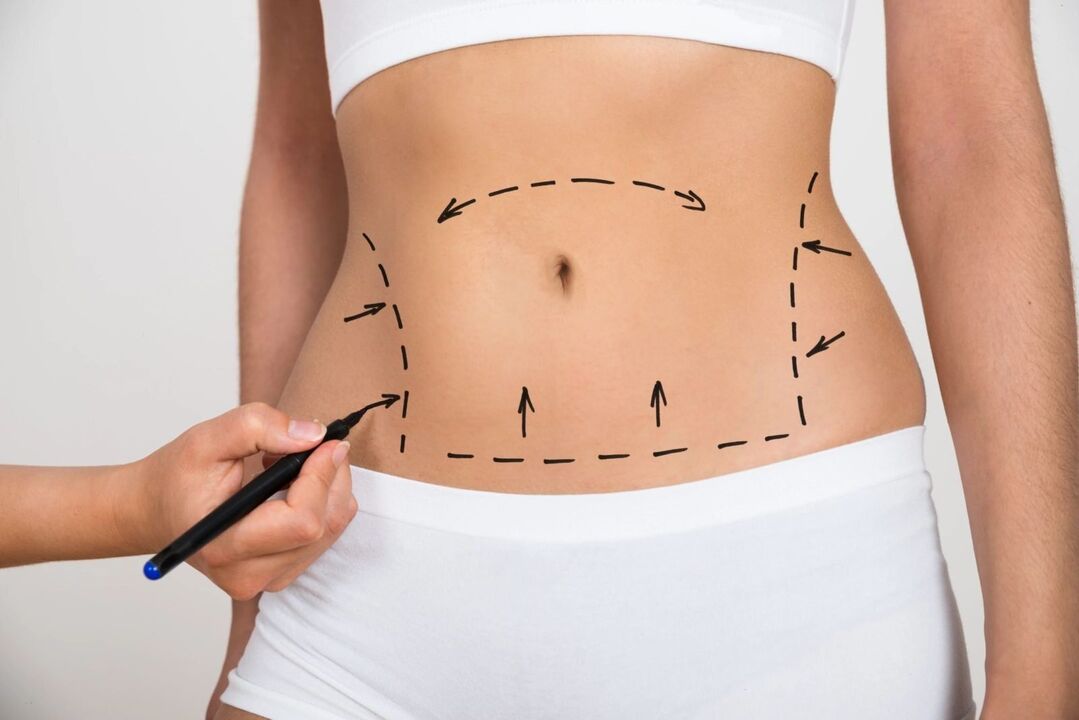 Marking the abdomen before liposuction, correcting the figure